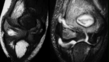 MR of lateral condyle fracture. Milch II and unstable elbow. T2 image with fat saturation on the right shows cartilaginous fracture. Fracture-fragment surrounded by synovial fluid. (Courtesy of Lynne Steinbach, M.D. Univ. of California, San Francisco)